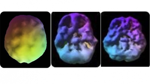 1st: The healthy pre-frontal cortex. 2nd: 18 year old­—3 year history of 4 times a week use. Underside view shows decreased pre-frontal cortex and temporal lobe activity. 3rd: 28 year old—10 year use. Underside also shows decreased activity. 