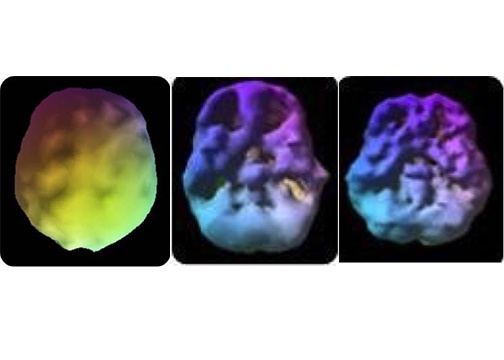 1st: The healthy pre-frontal cortex. 2nd: 18 year old­—3 year history of 4 times a week use. Underside view shows decreased pre-frontal cortex and temporal lobe activity. 3rd: 28 year old—10 year use. Underside also shows decreased activity. 